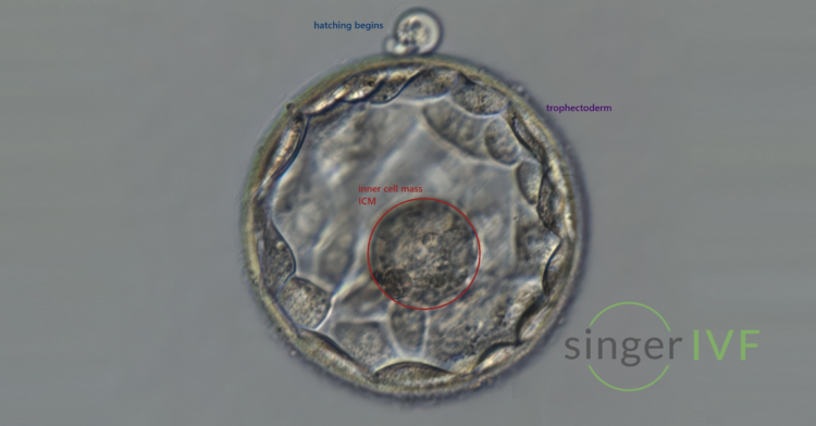 Annotated blastocyst in Singer IVF lab