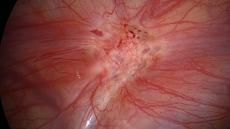 Endo fossa
