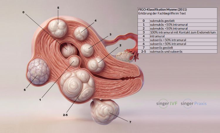Fibroid figo mag