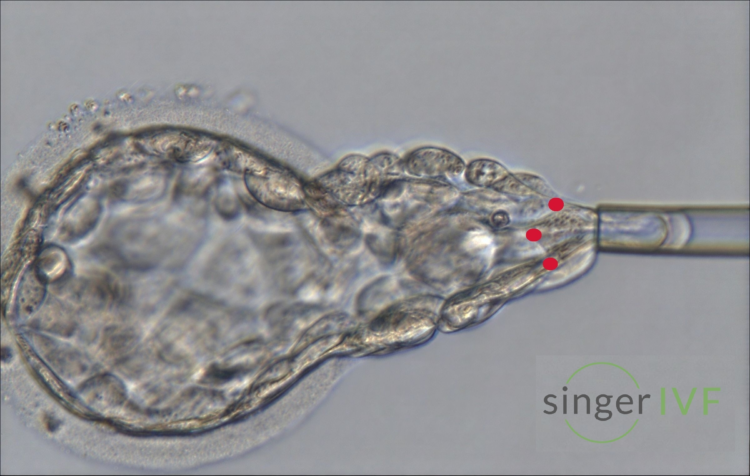 Singer IVF - PGT-A biopsy