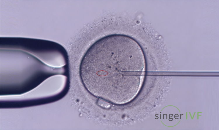 Singer IVF - ICSI procedure