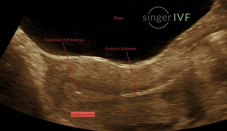 Embryotransfer in die Gebärmutter im IVF-Labor