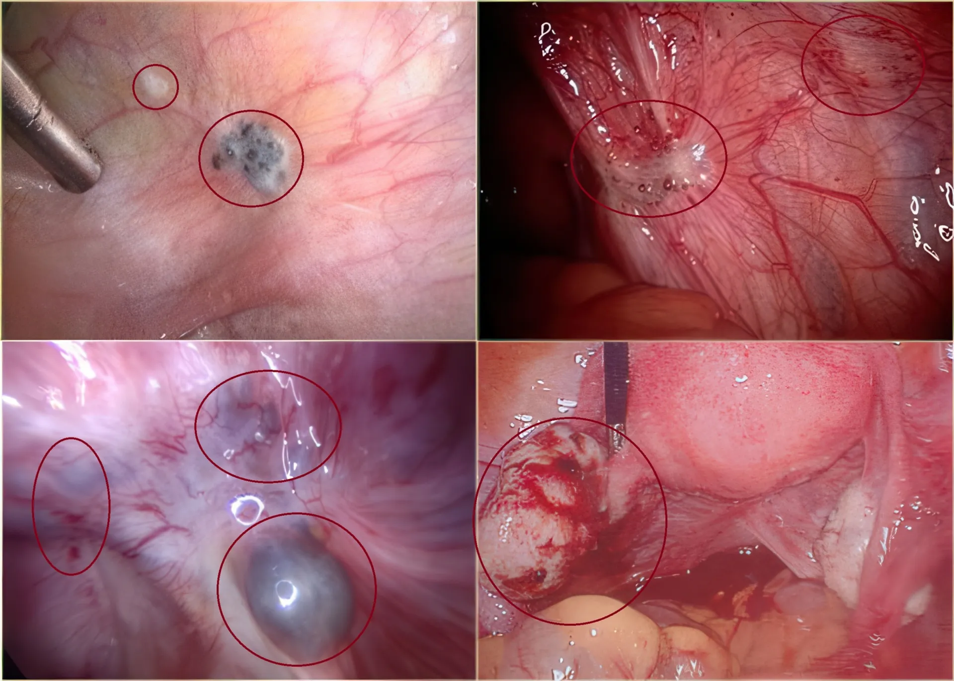 Endometriosis