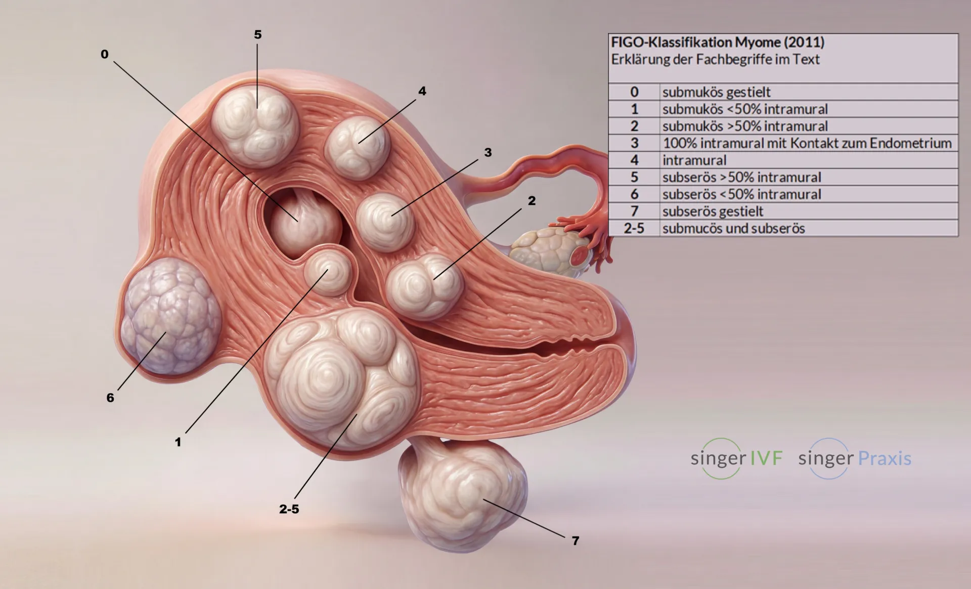 Fibroid figo mag