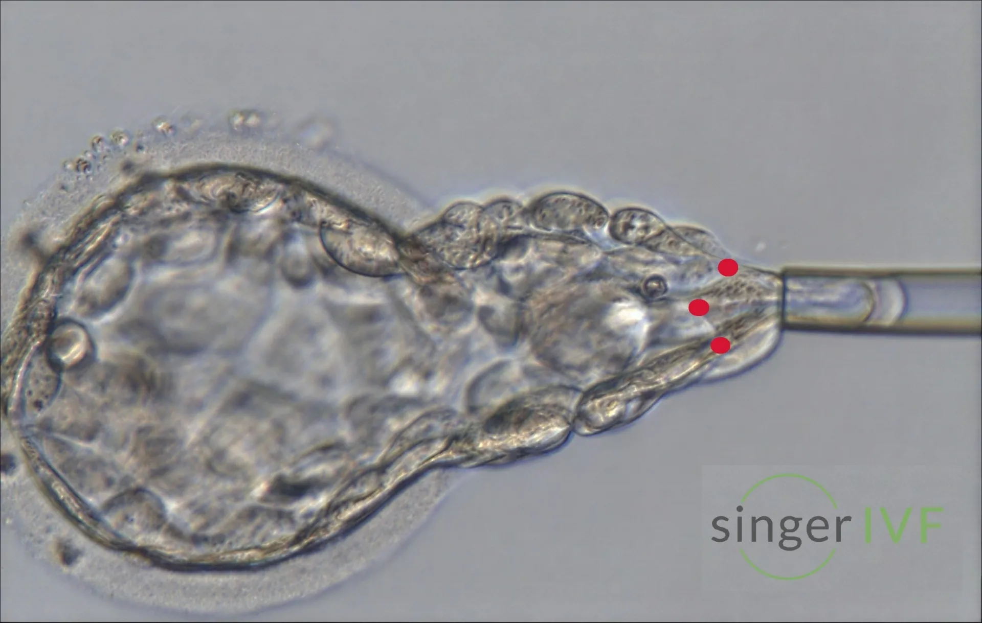 Singer IVF - PGT-A biopsy