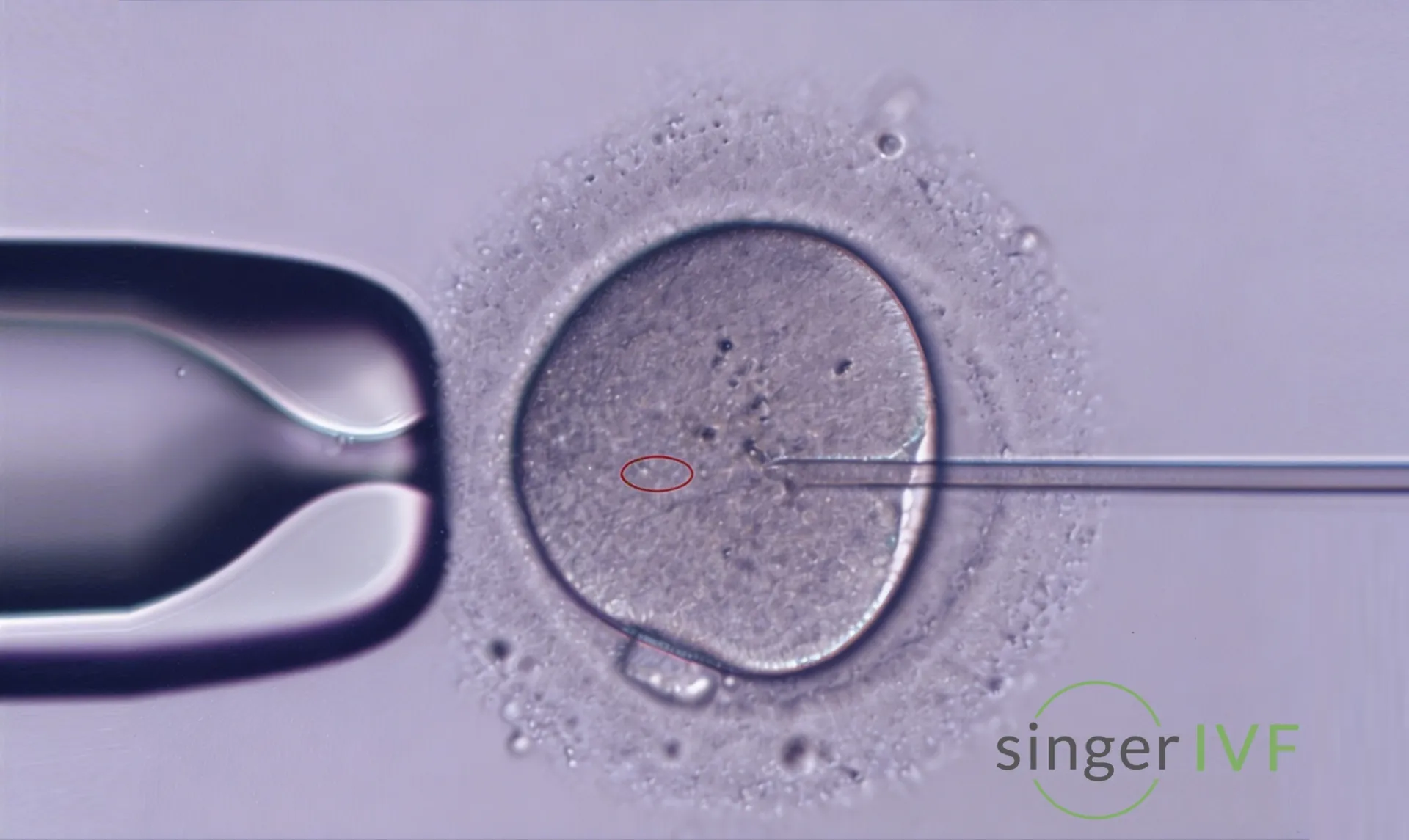 Singer IVF - ICSI procedure